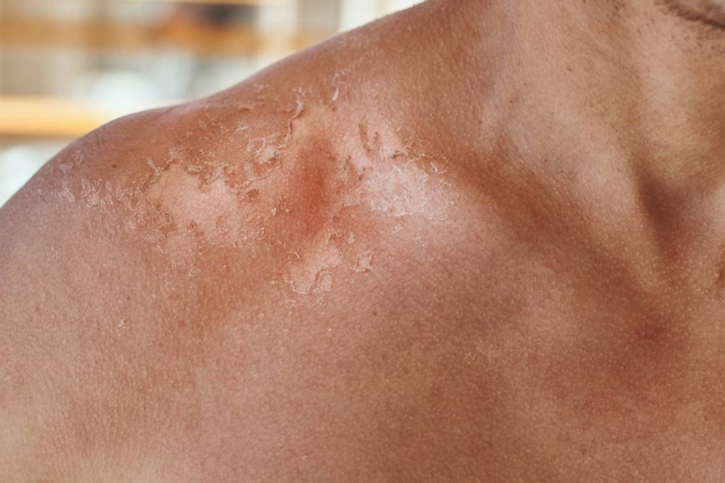 Sunburn on the shoulders of men. Shoulders with hurt skin fron sun burn, closeup
