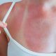 Burnt red skin, sunburn, excessive sun exposure, painful dermatological problem. body young woman, girl, with traces of sunburn